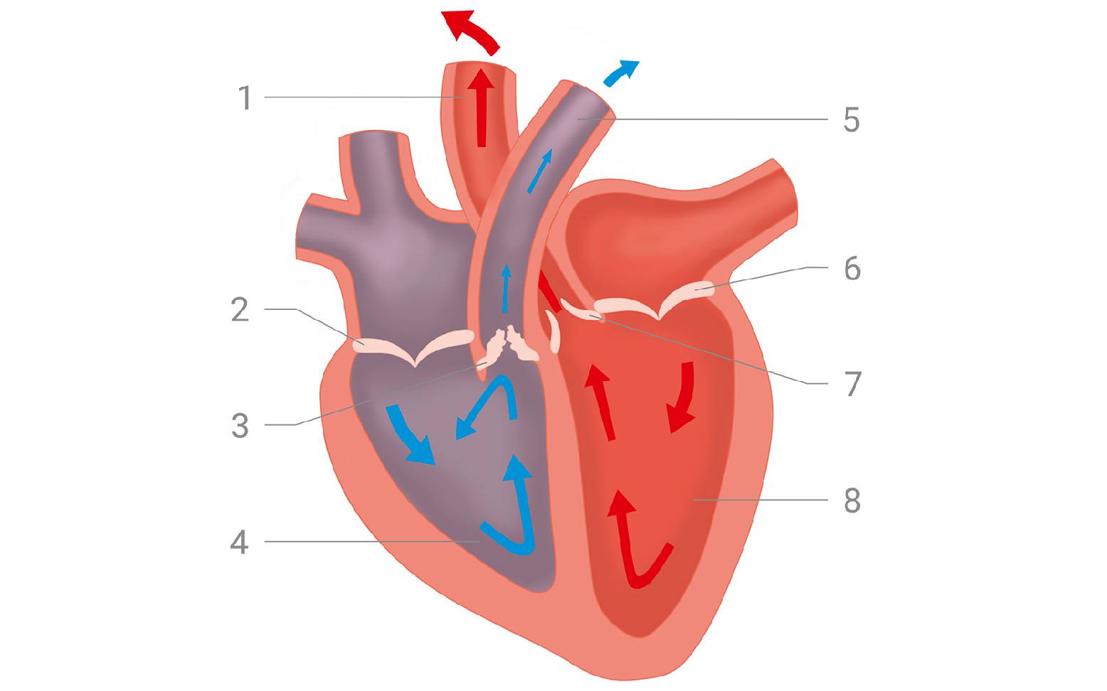 Schematic diagram of pulmonary stenosis