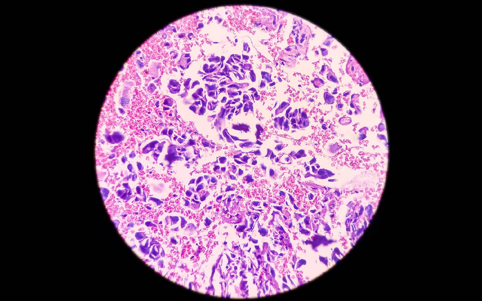 Osteosarkomzellen im Mikroskop