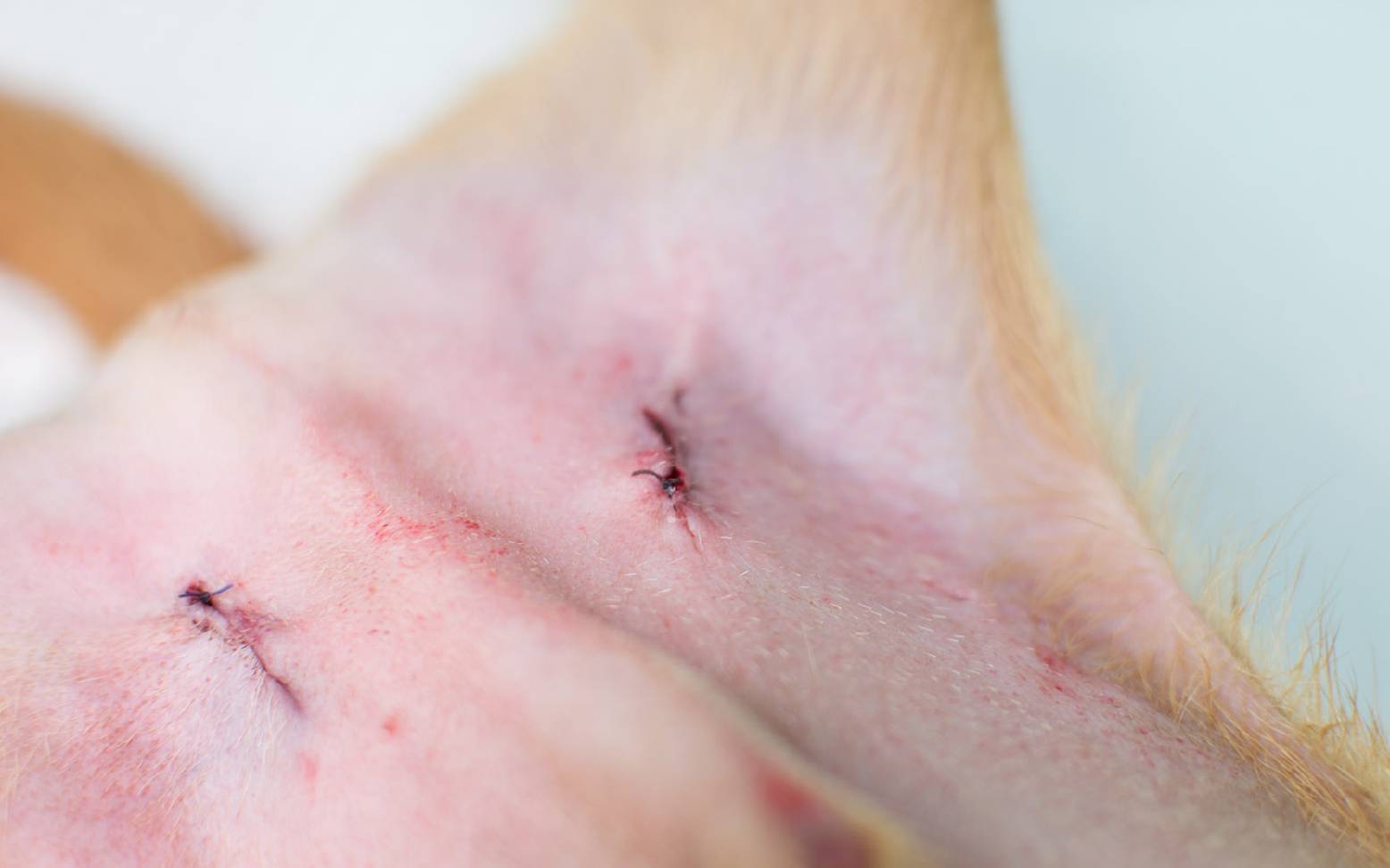 Kryptorchismus Operationsnähte