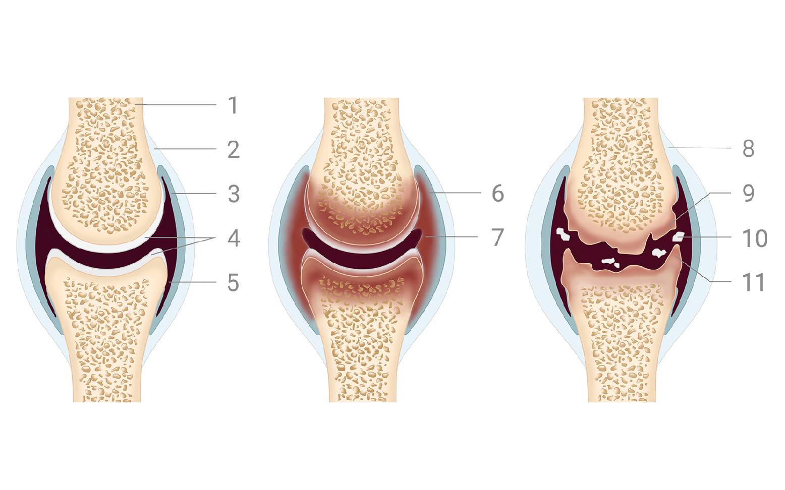 Gesundes Gelenk, Arthritis, Arthrose