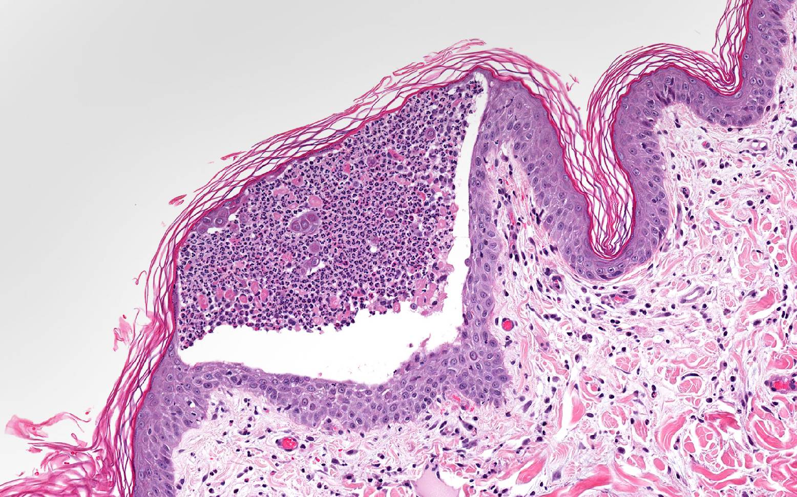 Microscopic image of pemphigus