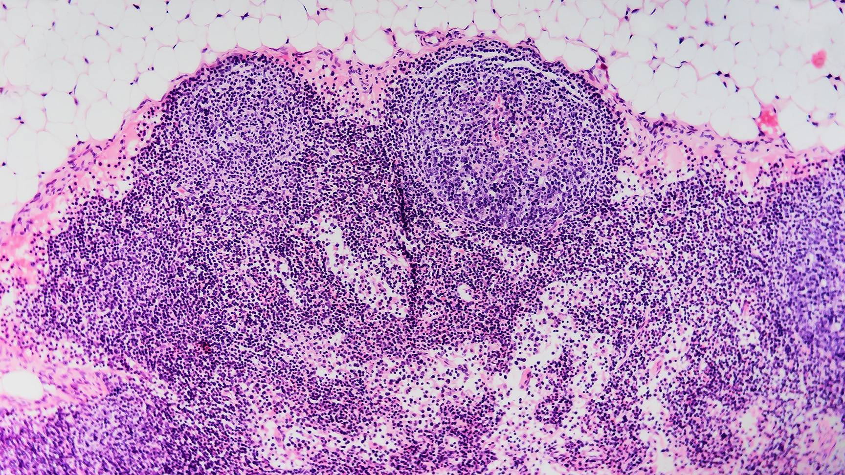 Microscopic image lymphoma