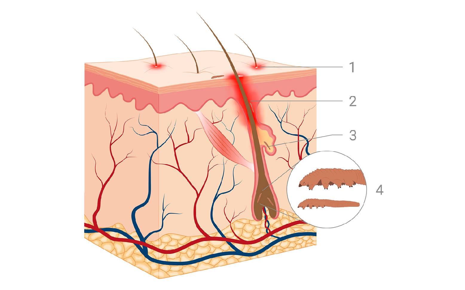 Schema Haut Demodex-Infektion