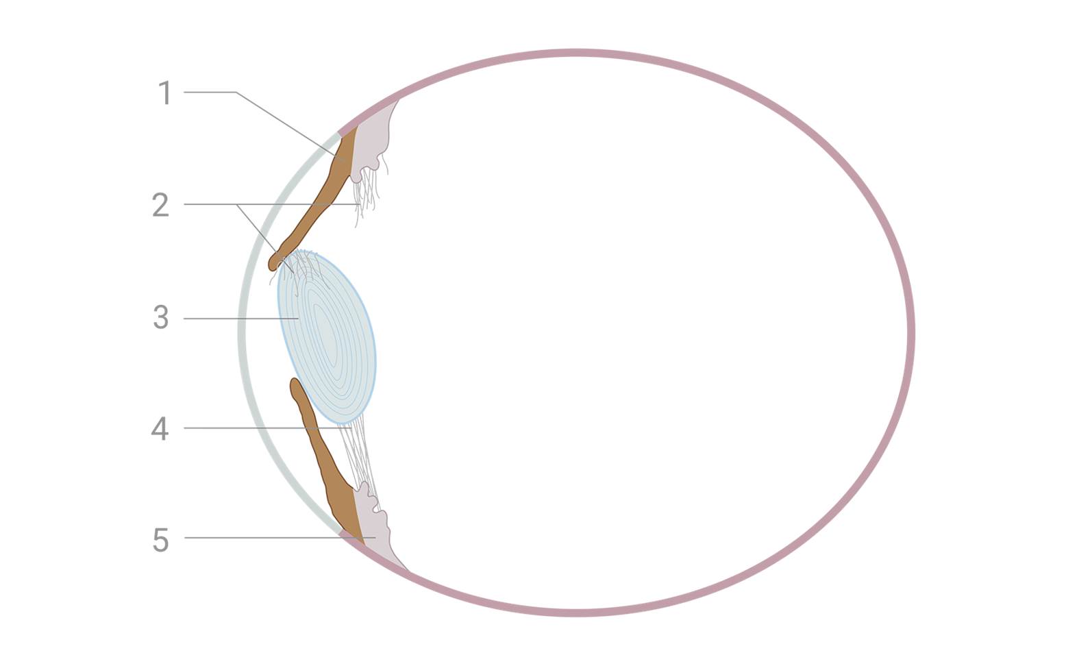 Schematic diagram of lens dislocation