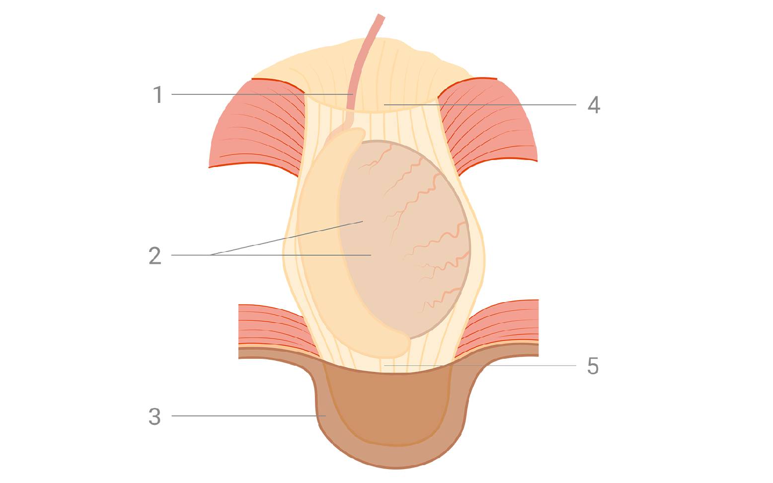 Schematic diagram of inguinal cryptorchidism 