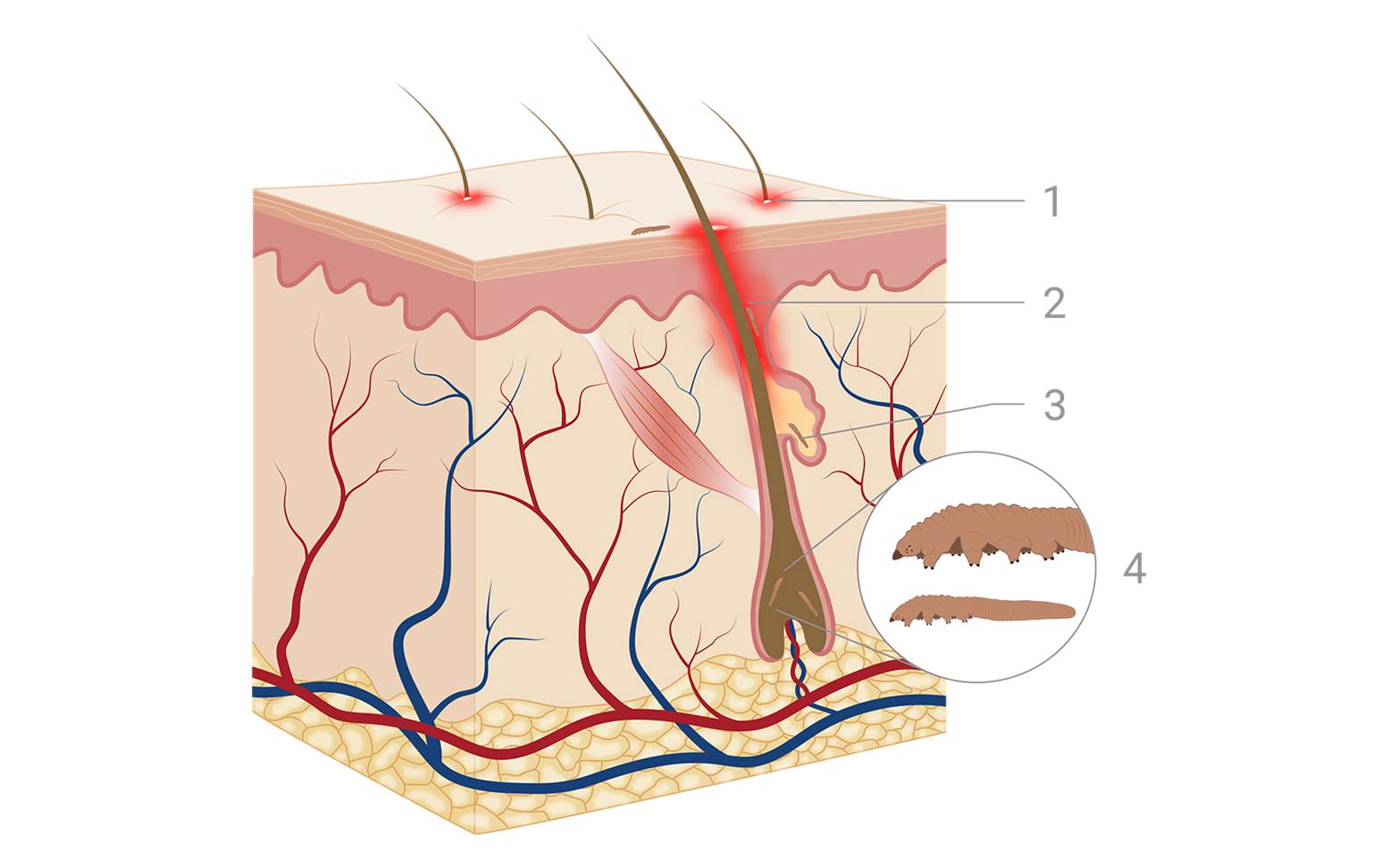 Schema Haut Demodex-Infektion