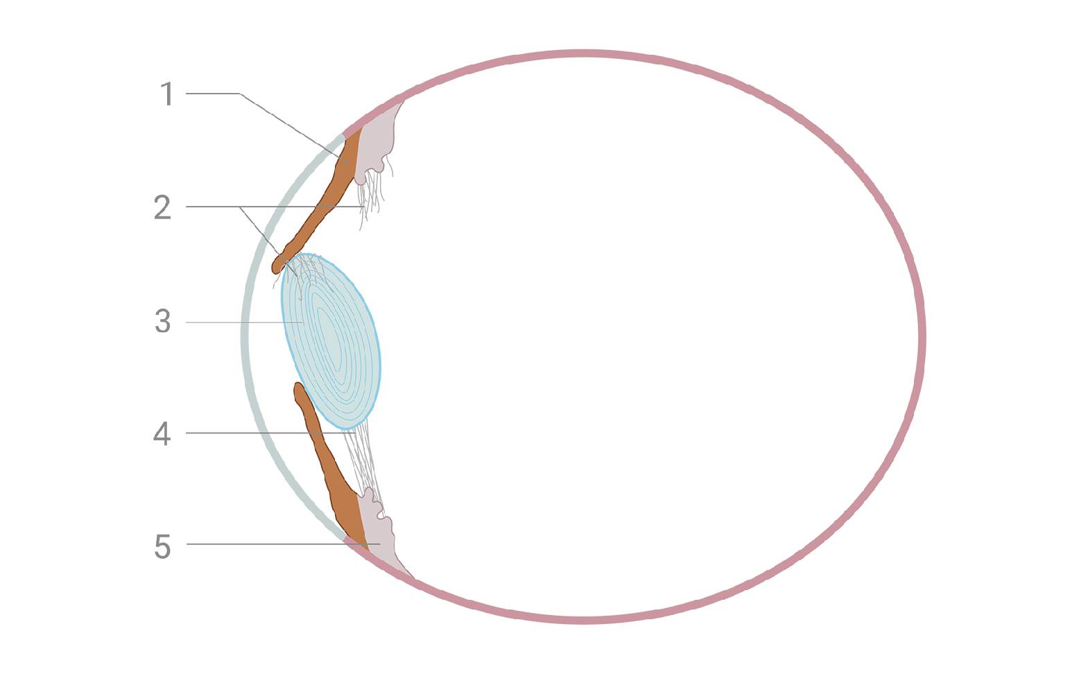 Schematic diagram of lens dislocation