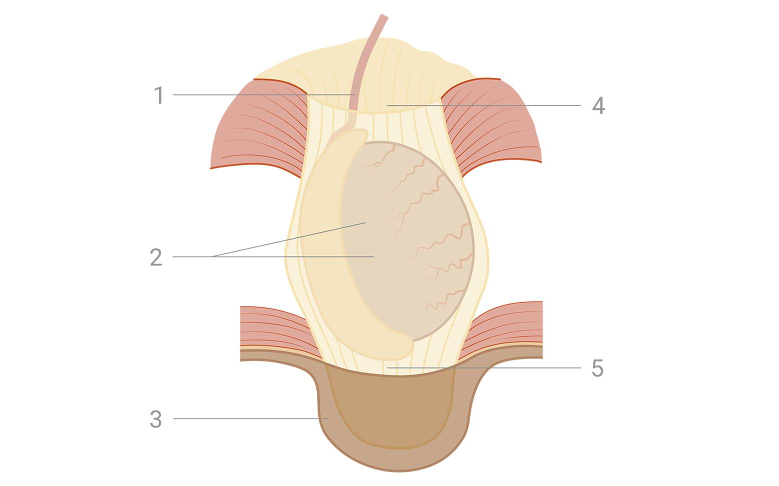 Schema inguinaler Kryptorchismus 