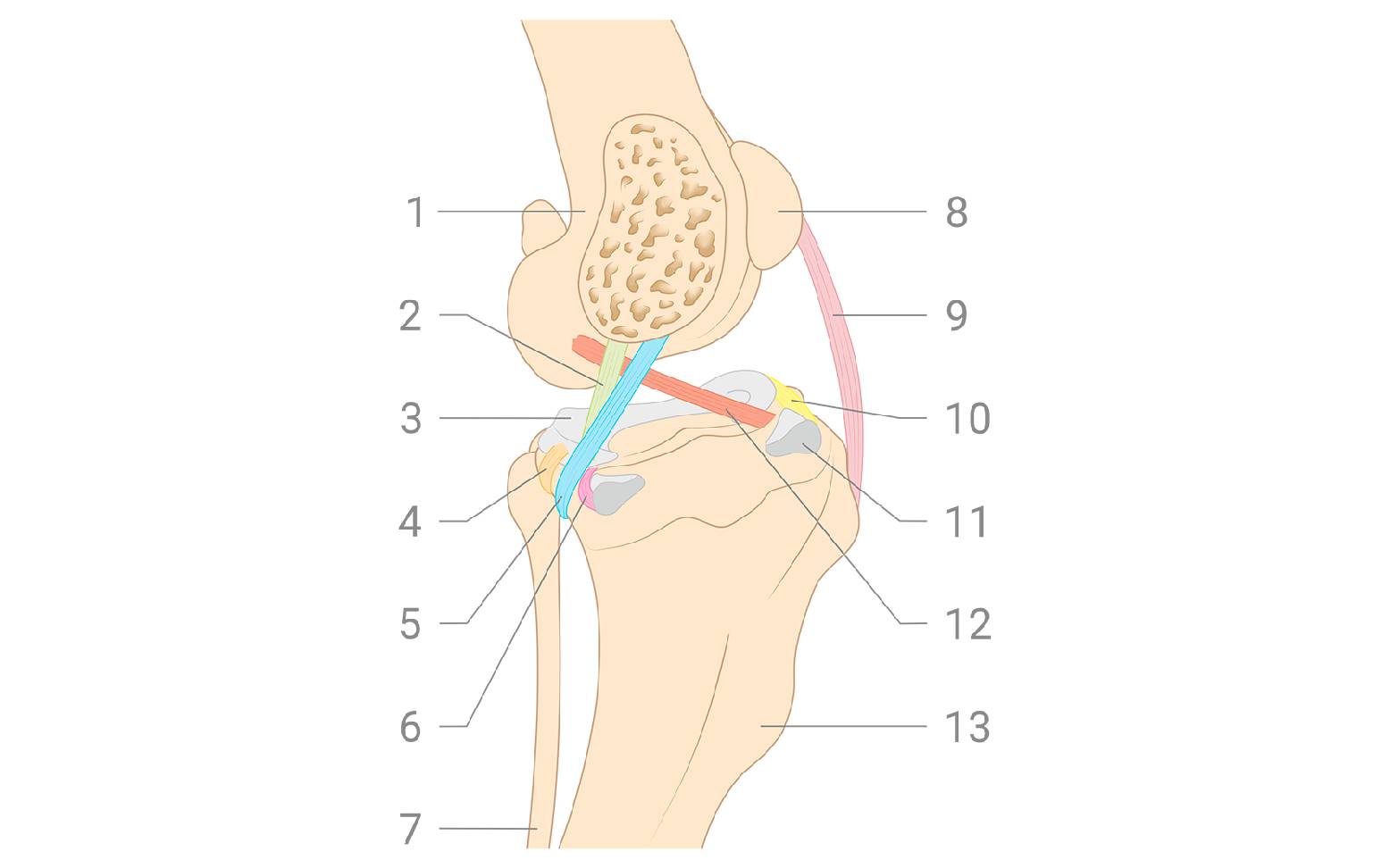Diagram of a torn cruciate ligament in the knee